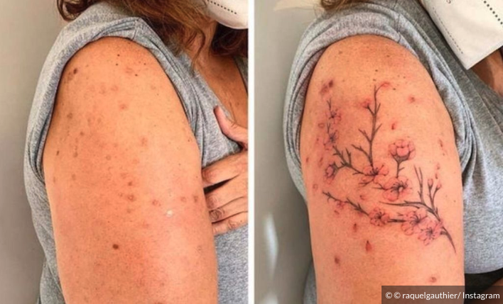 Capture decran le 2025 11 03 a 16.13.59 Elle transforme sa cicatrice en œuvre d’art… le résultat est incroyable