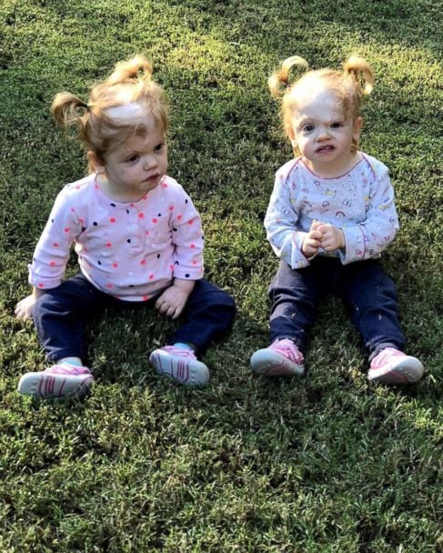 erin abby delaney 01 ht jef 190123 hpMain 4x5 608 1 Elles étaient siamoises et leur transformation fait halluciner tout le monde