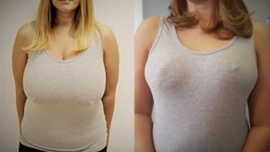 resultat reduction mammaire Transformation spectaculaire : les photos parlent d’elles-mêmes