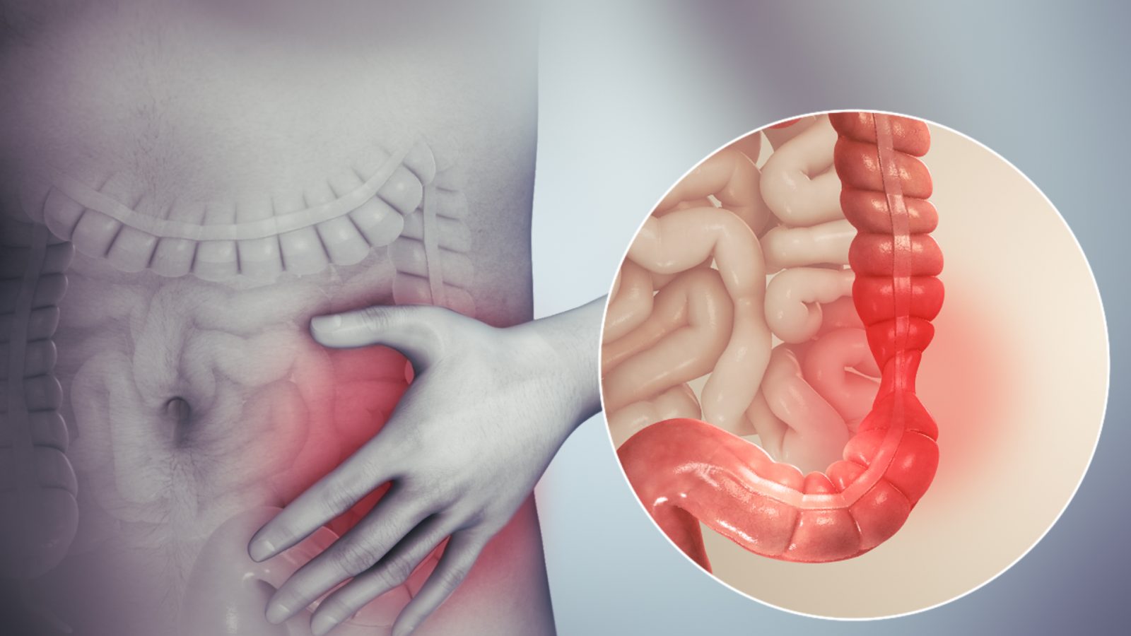 "Syndrome du colon irritable : comprendre, traiter et soulager les symptômes" 1 "Syndrome du colon irritable : comprendre, traiter et soulager les symptômes" Irritable bowel syndrome "Syndrome du colon irritable : comprendre, traiter et soulager les symptômes"