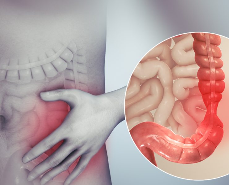 Irritable bowel syndrome "Syndrome du colon irritable : comprendre, traiter et soulager les symptômes"