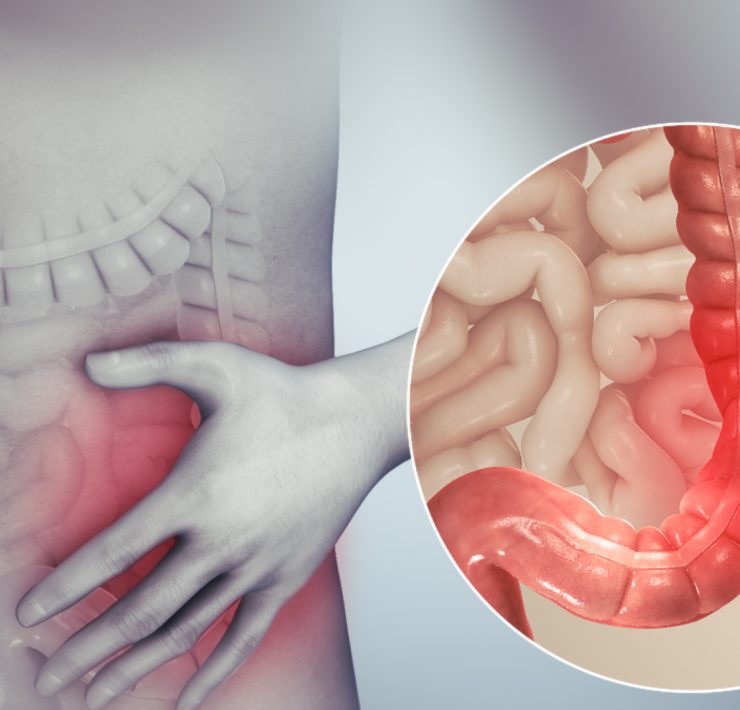 Irritable bowel syndrome "Syndrome du colon irritable : comprendre, traiter et soulager les sympt&ocirc;mes"