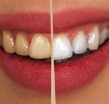 avoir dent blanche Comment se blanchir les dents naturellement et rapidement à la maison ?