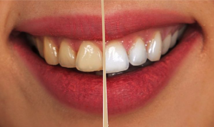 avoir dent blanche Comment se blanchir les dents naturellement et rapidement à la maison ?