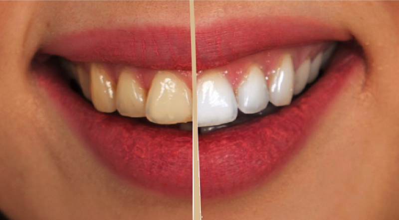 Comment se blanchir les dents naturellement et rapidement à la maison ? 1 Comment se blanchir les dents naturellement et rapidement à la maison ? avoir dent blanche Comment se blanchir les dents naturellement et rapidement à la maison ?