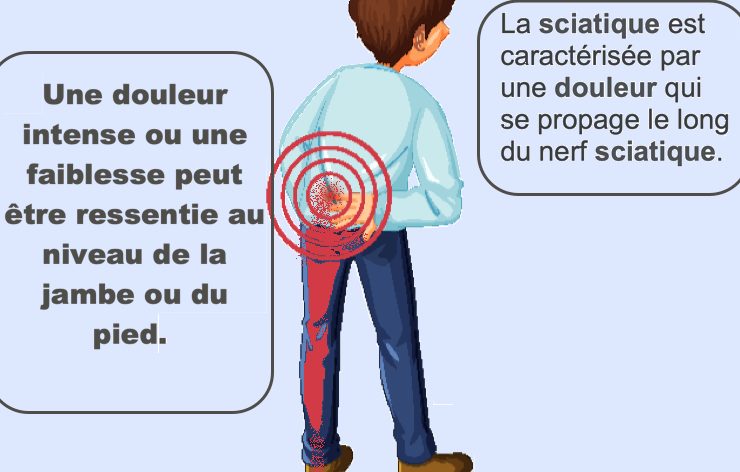 soulager la douleur du nerf sciatique Comment soulager la douleur du nerf sciatique ? Astuces naturelles pour s'en débarrasser