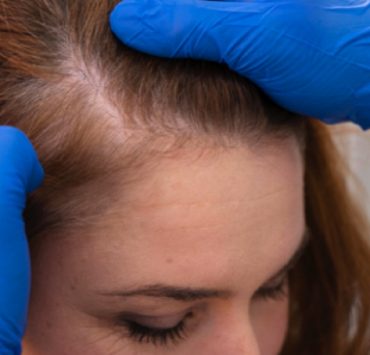 aliment contre chute cheveu Quels aliments manger contre la chute des cheveux ?