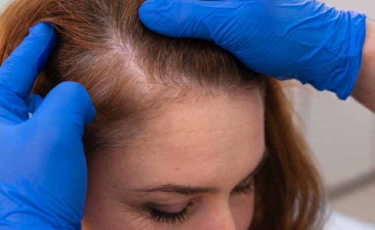 aliment contre chute cheveu Quels aliments manger contre la chute des cheveux ?