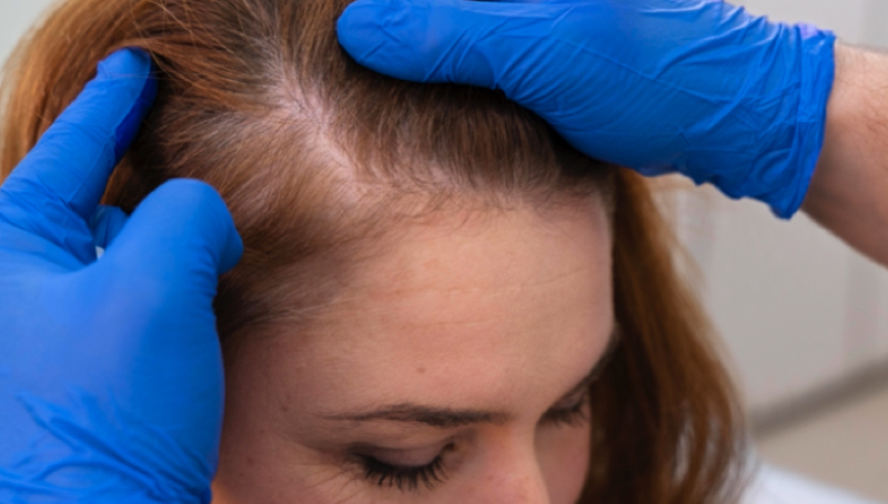 Quels aliments manger contre la chute des cheveux ? 1 Quels aliments manger contre la chute des cheveux ? aliment contre chute cheveu Quels aliments manger contre la chute des cheveux ?