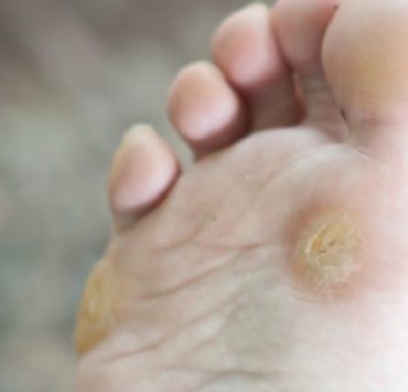 Comment enlever une verrue sous le pied rapidement ? 4 Comment enlever une verrue sous le pied rapidement ? enlever verrue plantaire Comment enlever une verrue sous le pied rapidement ?