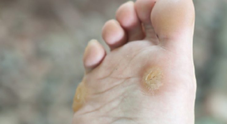 enlever verrue plantaire Comment enlever une verrue sous le pied rapidement ?