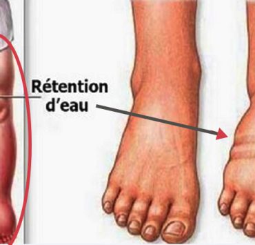 retention eau Comment se débarrasser de la rétention d'eau ?