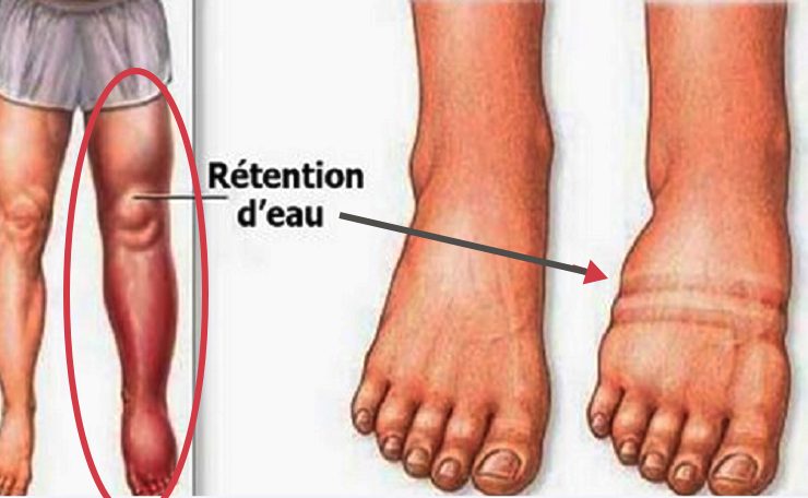 retention eau Comment se débarrasser de la rétention d'eau ?