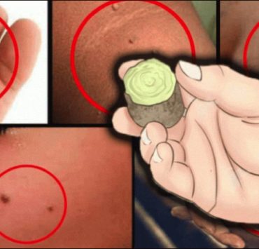 se debarrasser accrocordons verrues Comment faire disparaître verrues et acrochordons rapidement ?