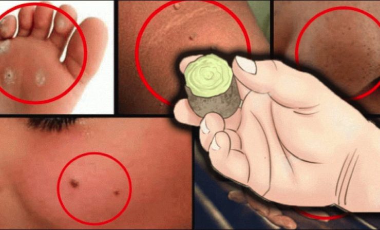 se debarrasser accrocordons verrues Comment faire disparaître verrues et acrochordons rapidement ?