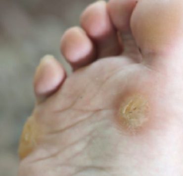 Comment enlever la corne sous les pieds ? 4 Comment enlever la corne sous les pieds ? avoir cor callosite corne sous pied Comment enlever la corne sous les pieds ?