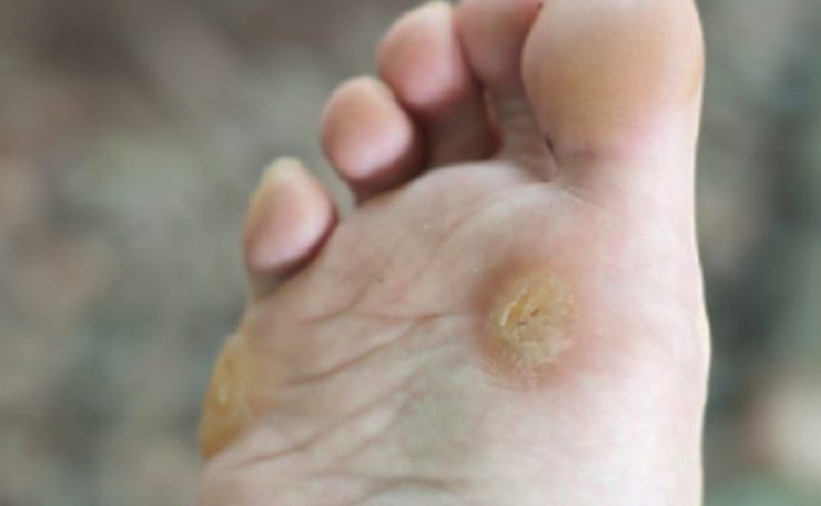 avoir cor callosite corne sous pied Comment enlever la corne sous les pieds ?