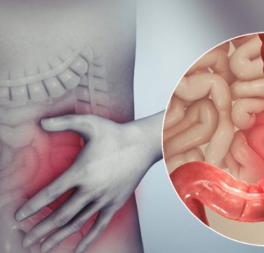 colon irritable soulager Comment soulager rapidement le côlon irritable ?