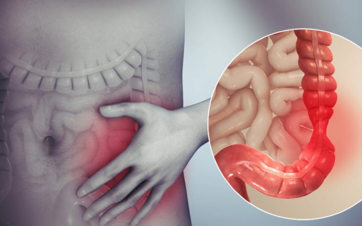 colon irritable soulager Comment soulager rapidement le côlon irritable ?