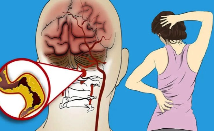 avc signe a savoir Quels sont les signes d'alerte d'un début d'AVC ?