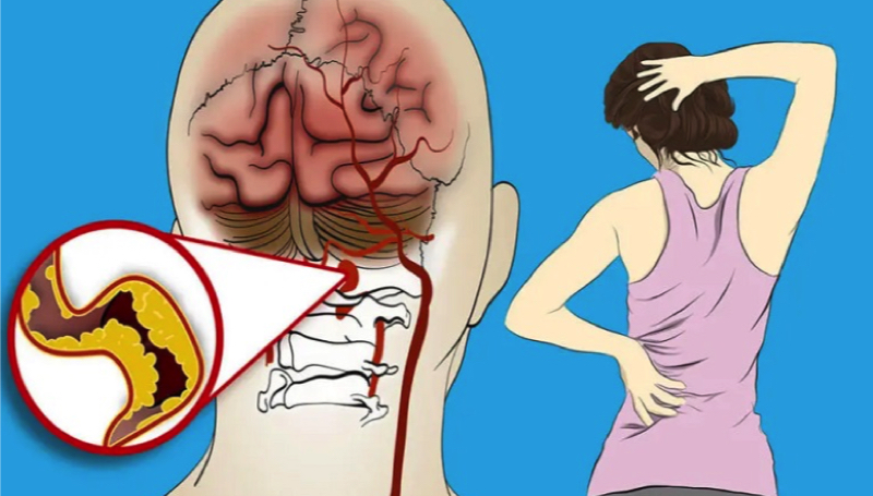 Quels sont les signes d'alerte d'un début d'AVC ? 1 Quels sont les signes d'alerte d'un début d'AVC ? avc signe a savoir Quels sont les signes d'alerte d'un début d'AVC ?