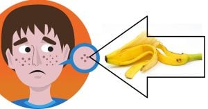 Qu'est-ce qu'on peut faire avec de la peau de banane ? Découvrez 13 Astuces Ingénieuses ! 3 Qu'est-ce qu'on peut faire avec de la peau de banane ? Découvrez 13 Astuces Ingénieuses ! banane acnes Qu'est-ce qu'on peut faire avec de la peau de banane ? Découvrez 13 Astuces Ingénieuses !