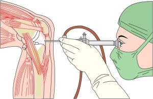 cause douleur genou Comment soulager les douleurs au genou avec des remèdes naturels ?