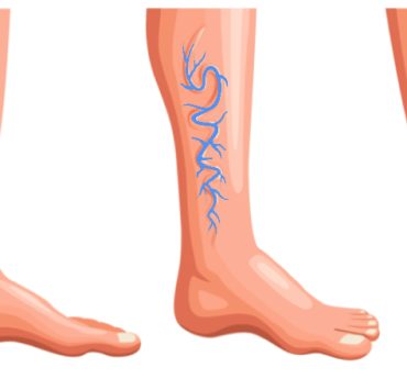 comment faire veine bleu jambe Comment faire disparaître les veines bleues sur les jambes ?