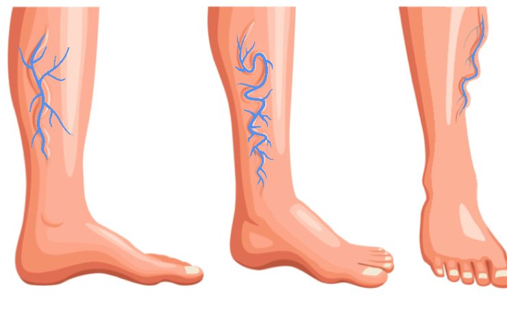 comment faire veine bleu jambe Comment faire disparaître les veines bleues sur les jambes ?