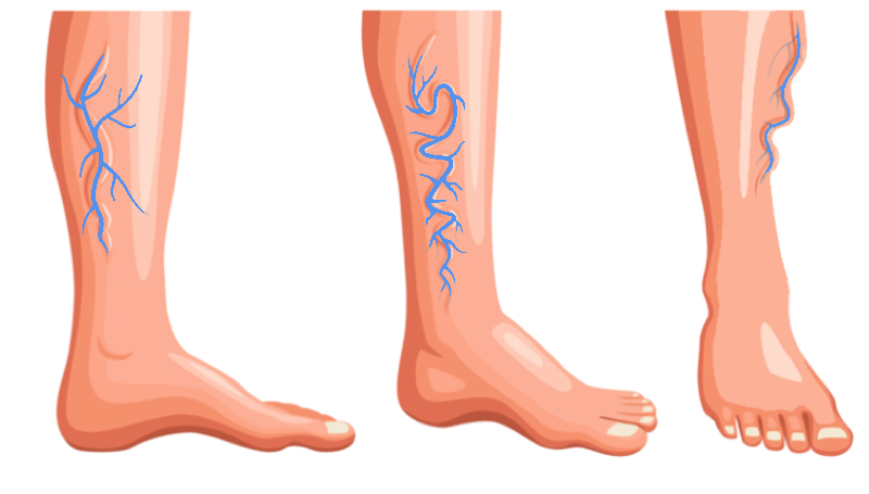 Comment faire disparaître les veines bleues sur les jambes ? 1 Comment faire disparaître les veines bleues sur les jambes ? comment faire veine bleu jambe Comment faire disparaître les veines bleues sur les jambes ?