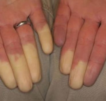 Pourquoi mes doigts deviennent blancs en hiver ? 6 Pourquoi mes doigts deviennent blancs en hiver ? maladie raynaud doigt blan hiver Pourquoi mes doigts deviennent blancs en hiver ?