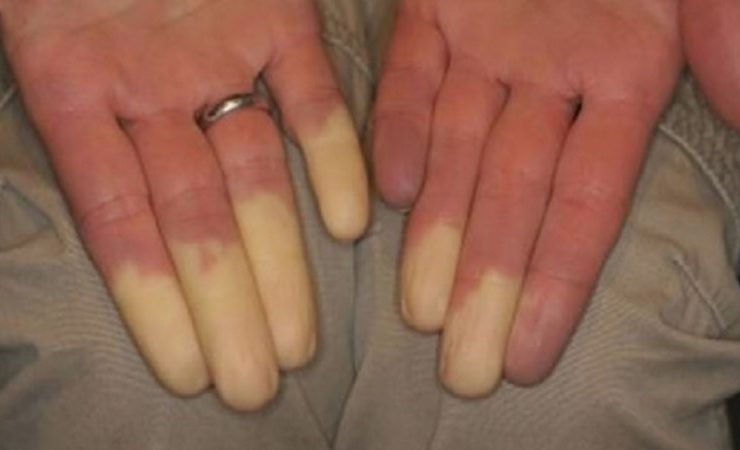 maladie raynaud doigt blan hiver Pourquoi mes doigts deviennent blancs en hiver ?