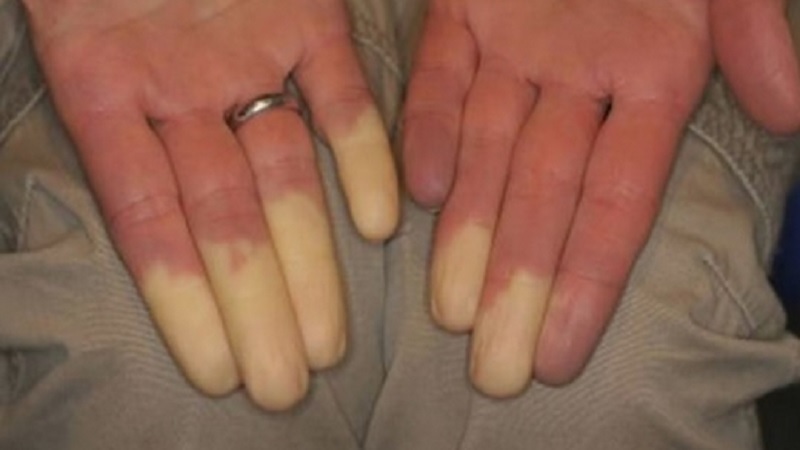 Pourquoi mes doigts deviennent blancs en hiver ? 1 Pourquoi mes doigts deviennent blancs en hiver ? maladie raynaud doigt blan hiver Pourquoi mes doigts deviennent blancs en hiver ?