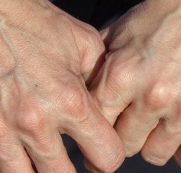 veine apparente Pourquoi certaines personnes ont-elles les veines apparentes ?