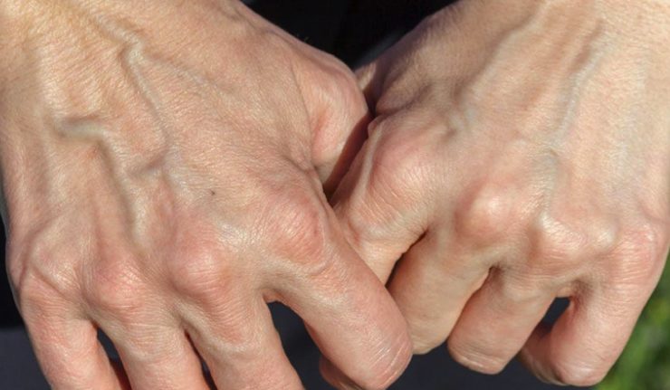 veine apparente Pourquoi certaines personnes ont-elles les veines apparentes ?