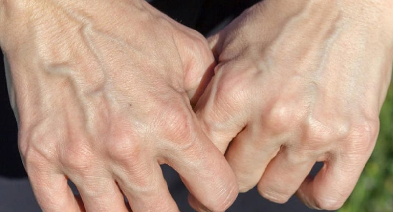 Pourquoi certaines personnes ont-elles les veines apparentes ? 1 Pourquoi certaines personnes ont-elles les veines apparentes ? veine apparente Pourquoi certaines personnes ont-elles les veines apparentes ?