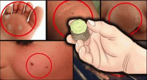 verrues produit efficace Quel est le produit le plus efficace contre les verrues ?