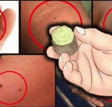 verrues produit efficace Quel est le produit le plus efficace contre les verrues ?