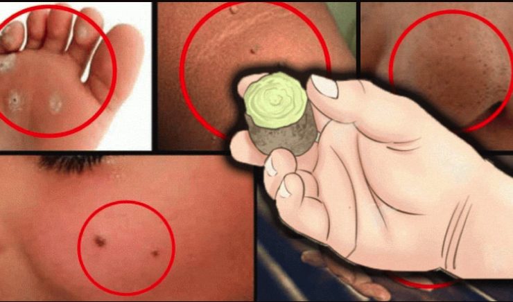 verrues produit efficace Quel est le produit le plus efficace contre les verrues ?