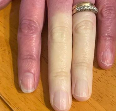 https s3 images.ladbible.com s3 content eb37bd64608784b0f31f5eed10787852 e1634817501686 Connaissez-vous la maladie qui rend les doigts blancs ?