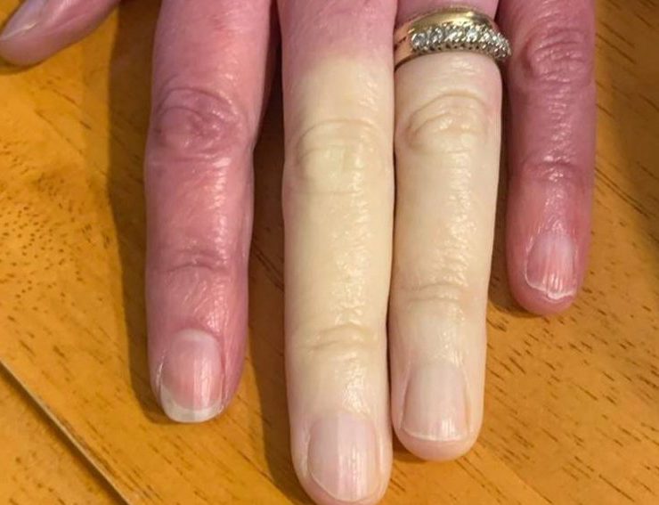 https s3 images.ladbible.com s3 content eb37bd64608784b0f31f5eed10787852 e1634817501686 Connaissez-vous la maladie qui rend les doigts blancs ?