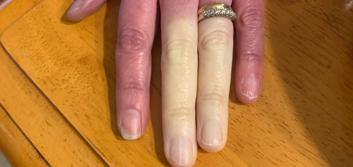 Connaissez-vous la maladie qui rend les doigts blancs ? 1 Connaissez-vous la maladie qui rend les doigts blancs ? https s3 images.ladbible.com s3 content eb37bd64608784b0f31f5eed10787852 e1634817501686 Connaissez-vous la maladie qui rend les doigts blancs ?
