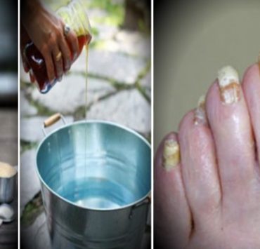 Champignons des ongles : La solution naturelle en 2 étapes pour une transformation radicale ! 3 Champignons des ongles : La solution naturelle en 2 étapes pour une transformation radicale ! une recette facile avec 2 ingredients bio seulement pour eliminer les champignons des ongles a jamais Champignons des ongles : La solution naturelle en 2 étapes pour une transformation radicale !