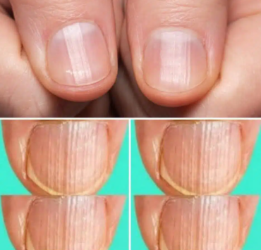 Que signifient des ongles striés ? 3 Que signifient des ongles striés ? Capture decran 2025 03 18 065831 Que signifient des ongles striés ?