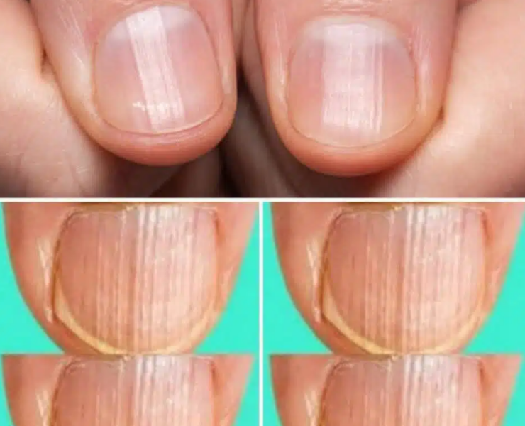 Capture decran 2025 03 18 065831 Que signifient des ongles striés ?