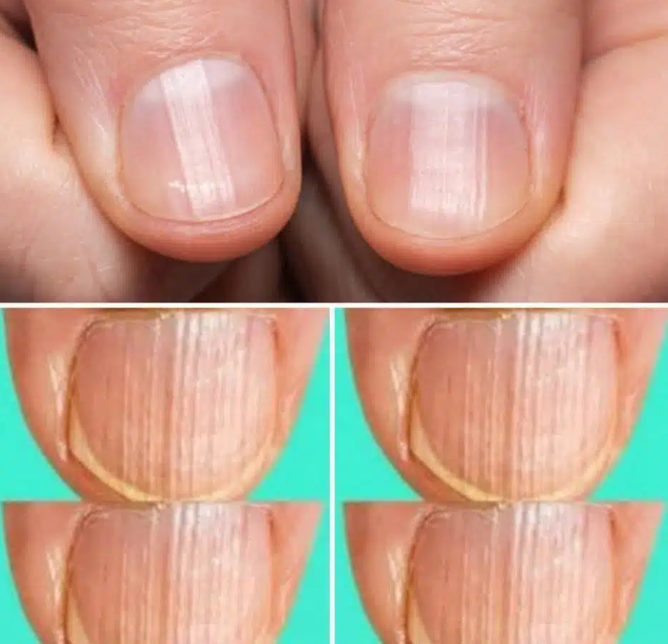 Que signifient des ongles striés ? 1 Que signifient des ongles striés ? Capture decran 2025 03 18 065831 Que signifient des ongles striés ?
