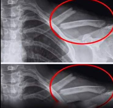 Cette boisson fragilise les os, et pourtant, de nombreuses personnes en boivent tous les jours 4 Cette boisson fragilise les os, et pourtant, de nombreuses personnes en boivent tous les jours Capture decran 2025 04 07 144336 Cette boisson fragilise les os, et pourtant, de nombreuses personnes en boivent tous les jours