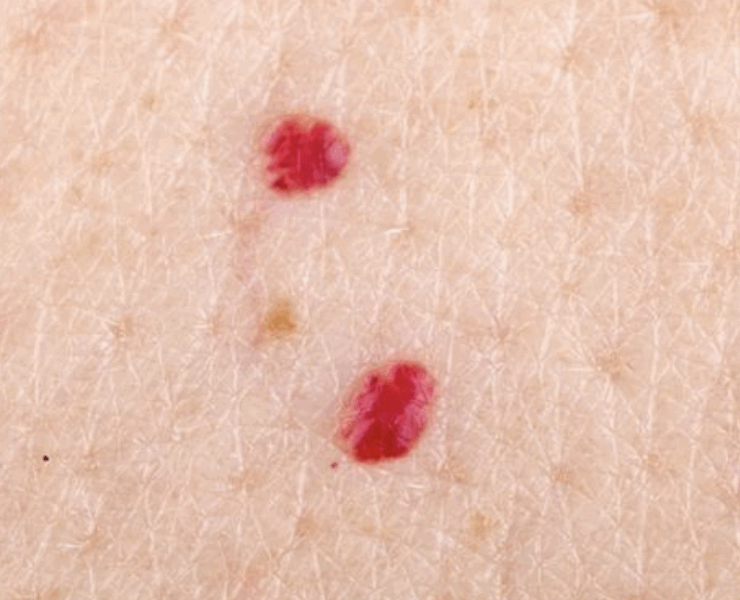 Capture decran le 2025 05 02 a 10.30.23 e1746197598342 Ces taches rouges qui apparaissent sans prévenir… faut-il s’en inquiéter ?