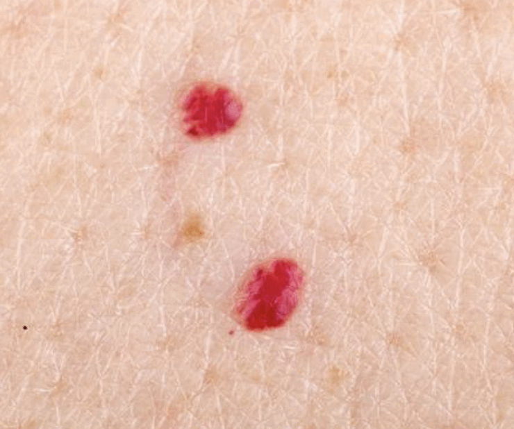 Capture decran le 2025 05 02 a 10.30.23 e1746197598342 Ces taches rouges qui apparaissent sans pr&eacute;venir&hellip; faut-il s&rsquo;en inqui&eacute;ter ?