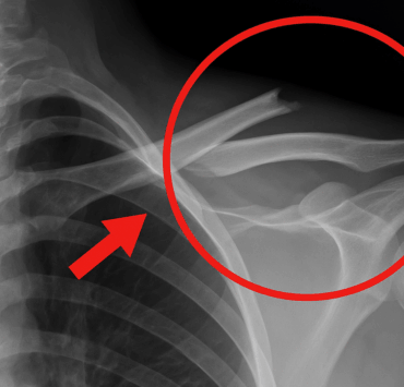 Vous buvez sûrement cette boisson chaque jour… mais elle détruit vos os ! 4 Vous buvez sûrement cette boisson chaque jour… mais elle détruit vos os ! osdetruit e1747313572755 Vous buvez sûrement cette boisson chaque jour… mais elle détruit vos os !